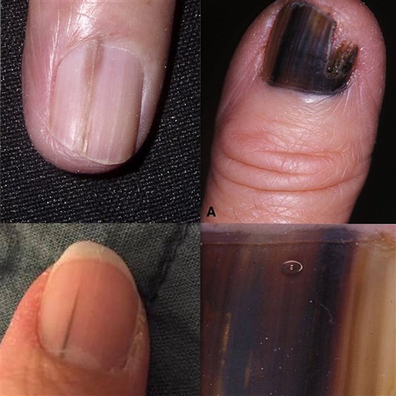What Does Nail Melanoma Look Like? Skin Cancer Can Hide as ...