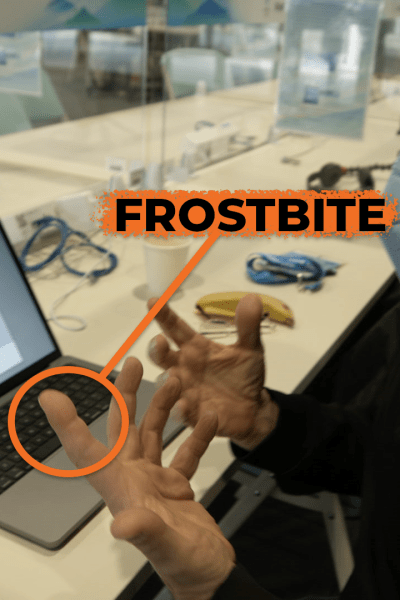 Photographer Mark Edward Harris shows his frostbitten finger