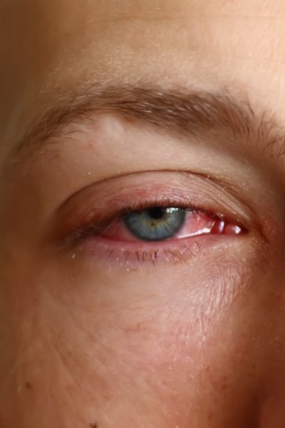 A person with pink eye.
